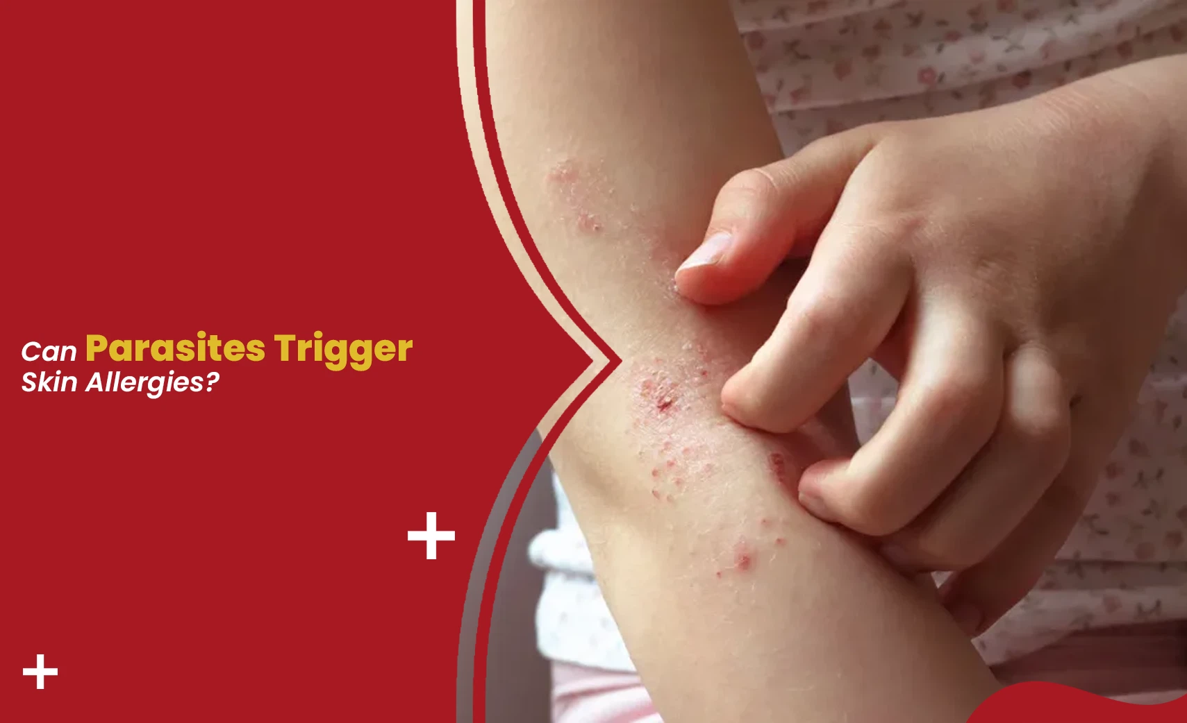 Person scratching itchy rash on arm showing parasites causing skin allergies and skin irritation