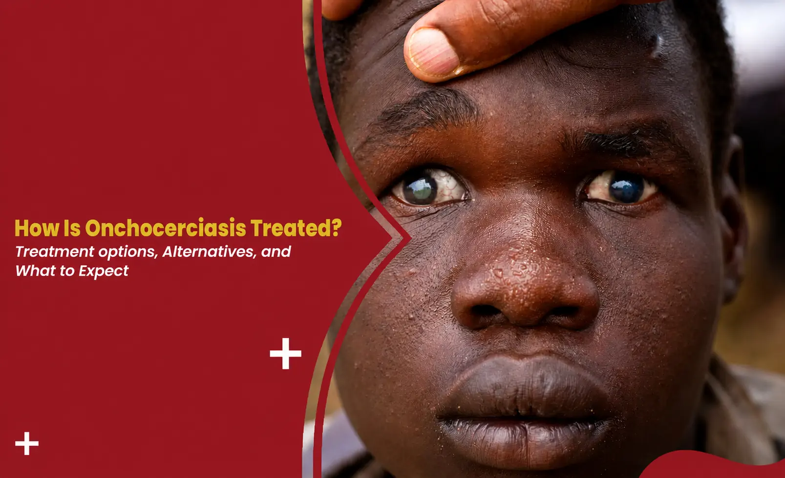 onchocerciasis treatment banner showing skin and eye symptoms of river blindness