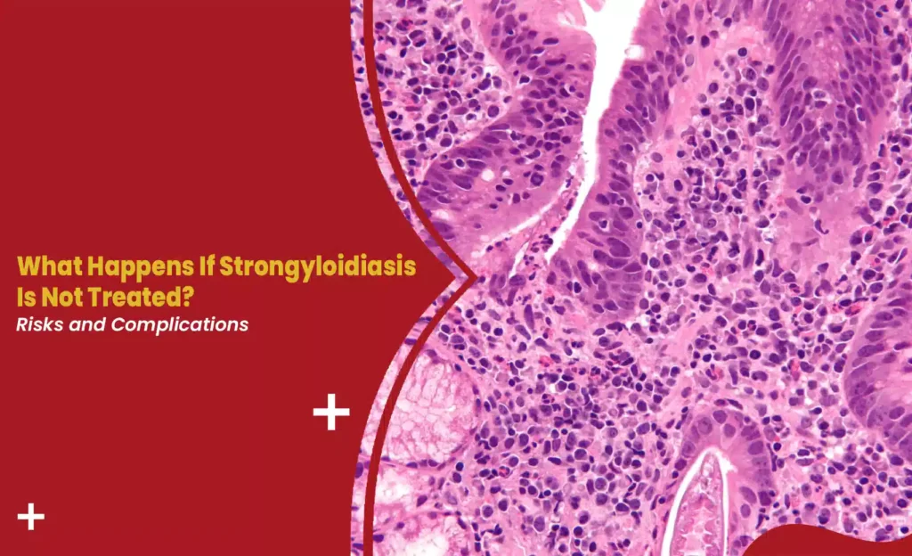 Untreated strongyloidiasis blog banner showing intestinal tissue histology with title "What Happens If Strongyloidiasis Is Not Treated? Risks and Complications