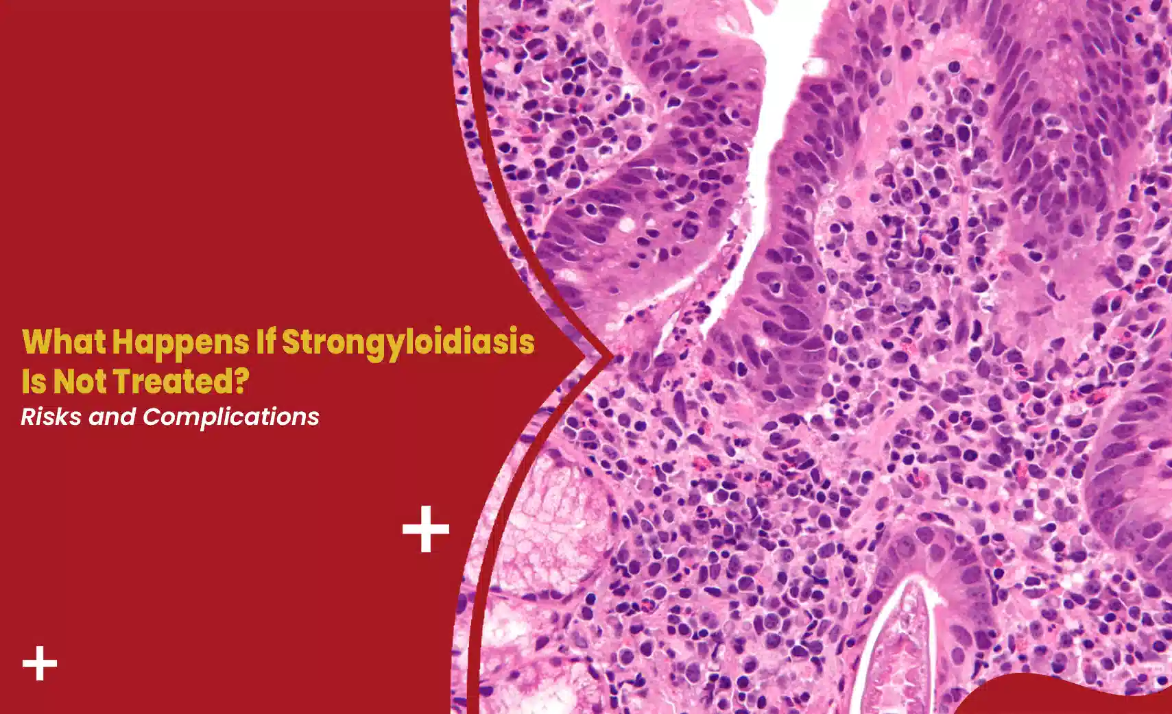 Untreated strongyloidiasis blog banner showing intestinal tissue histology with title "What Happens If Strongyloidiasis Is Not Treated? Risks and Complications