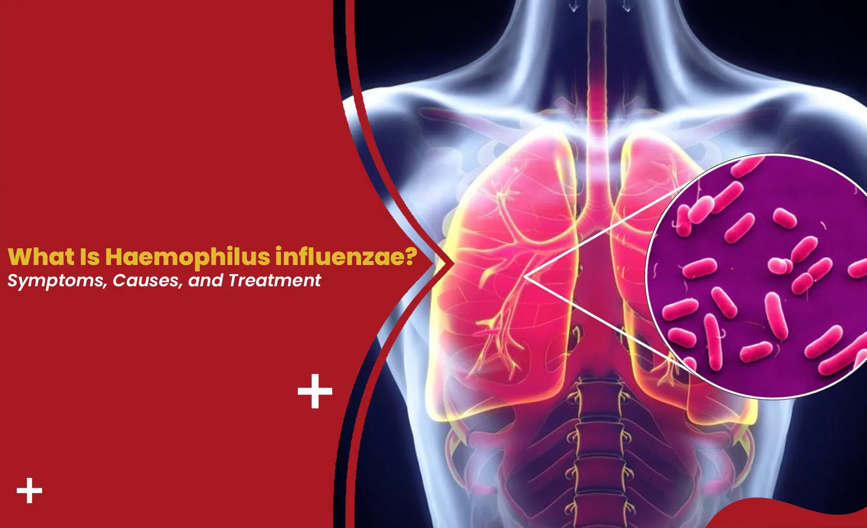 Illustration of Haemophilus influenzae infection showing the affected lungs and airways, with a magnified view of the rod-shaped bacteria