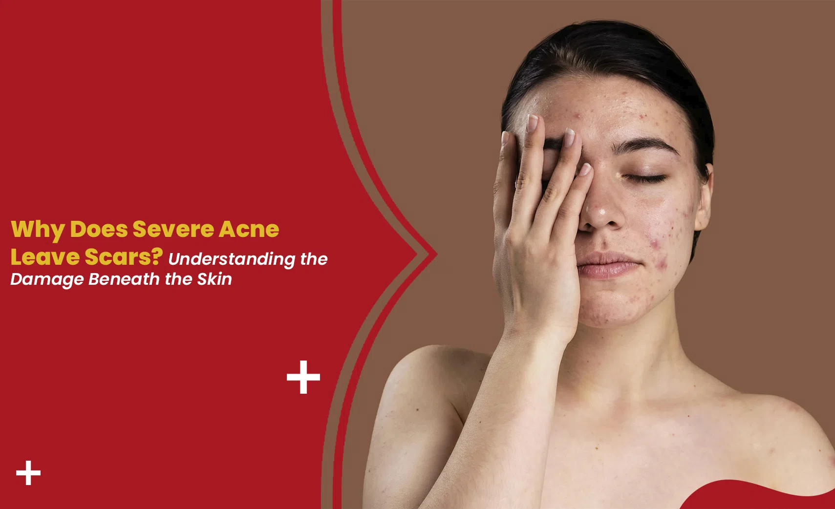 Severe acne scars on a woman's face